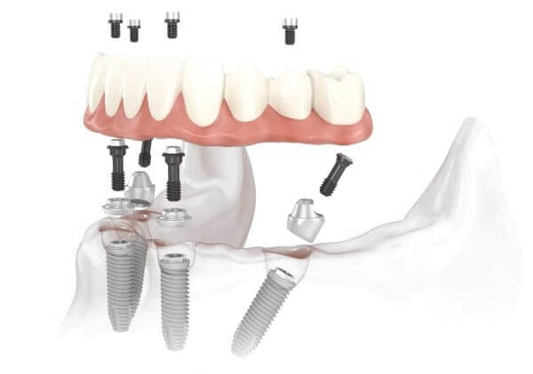 Illustration of All-on-4 Implants of the Lower Jaw