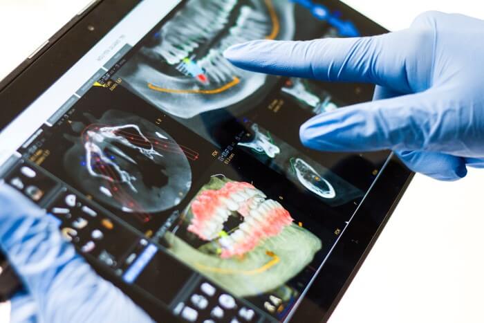 Digital Images showing Preparation for Full Arch Dental Implants