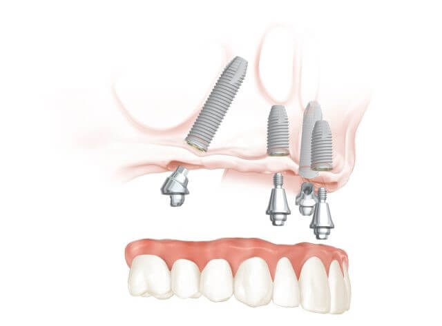 Illustration of Full Mouth Dental Implants of the Upper Jaw