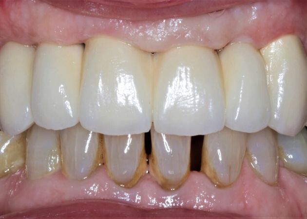Smile Restored With Multiple Teeth Implants Blackheath London