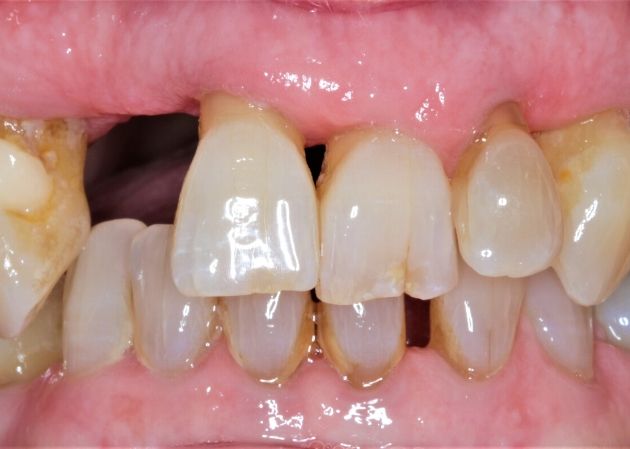 Smile Restored With Multiple Teeth Implants Blackheath London