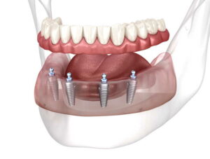 Are Implant Dentures Better than Regular Dentures?
