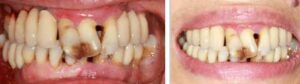 Dental Implants Blackheath - Case 4 1