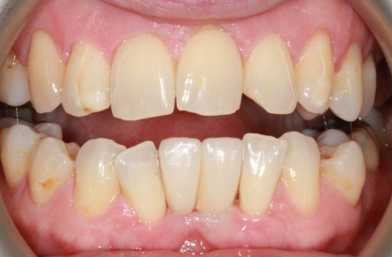 Dental Implants Blackheath – Case 3
