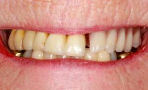 Dental Implants Blackheath - Case 1 1