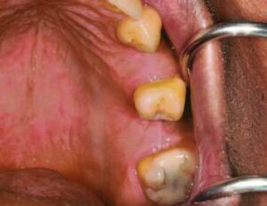 Dental Implants Blackheath - Case 2 1