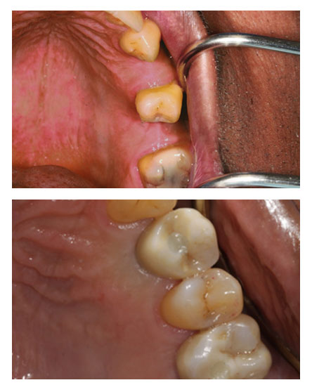 Dental Implants Blackheath – Case 2