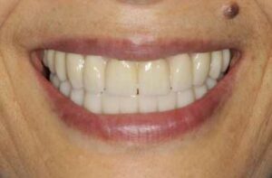Dental Implants Blackheath - Case 4 2