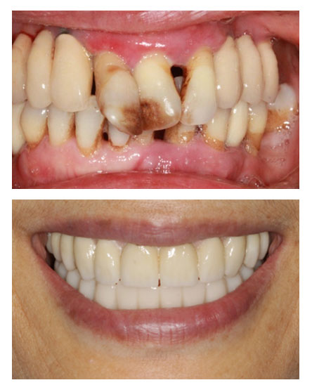 missing teeth treatment with implants