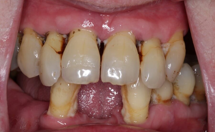 teeth after teeth in a day dental implants