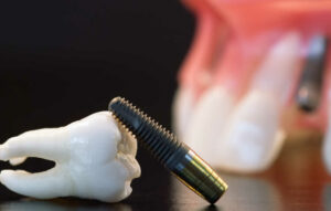 Lifespan of Dental Implants