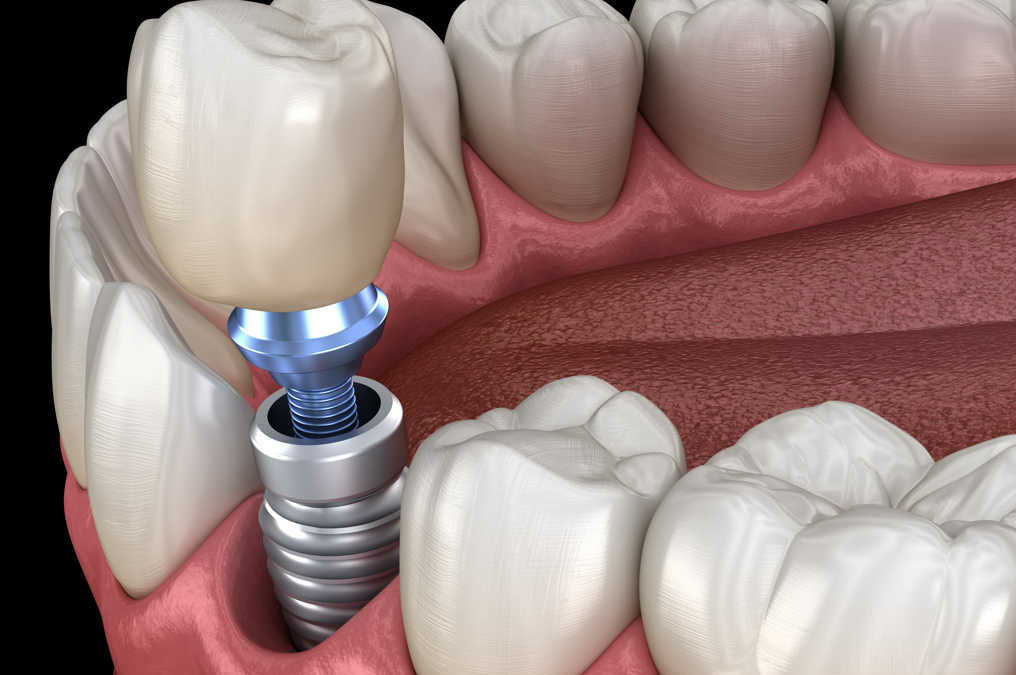 How Long do dental implants last?