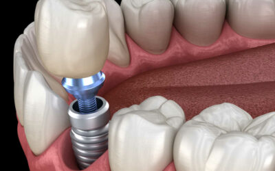How Long do dental implants last?