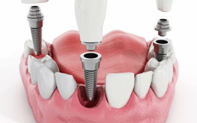 Is a Dental Implant Procedure Painful?