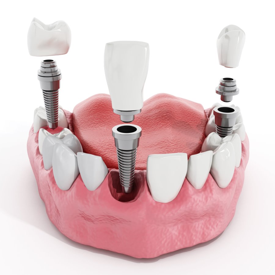 Is A Dental Implant Procedure Painful