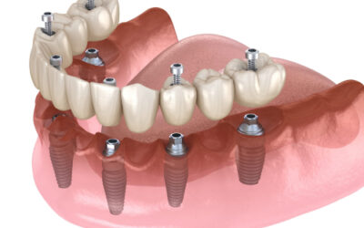 Smile in a Day: The Dental Implants ‘Teeth in a Day’ Protocol