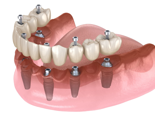 Smile in a Day: The Dental Implants ‘Teeth in a Day’ Protocol